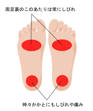 足根管症候群 足裏のしびれで厚い靴下を履いている感じ 本当の原因は トリガーポイント 筋膜アプローチ専門 整体院seek