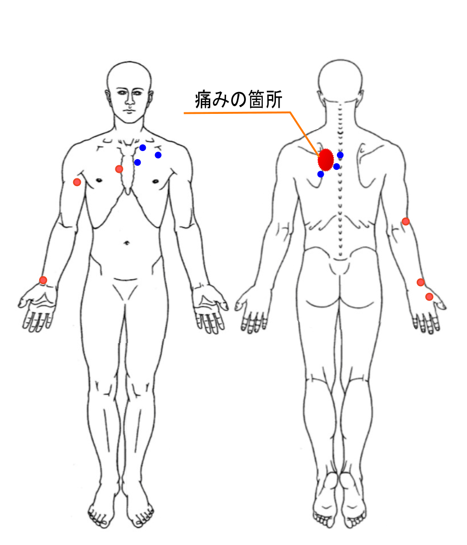 の 左側 背中 痛み 背中が痛む！痛む場所ごとに図で見る14の原因：肩こり？それとも他の病気？